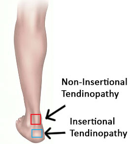 Achilles Tendinitis - Effective 